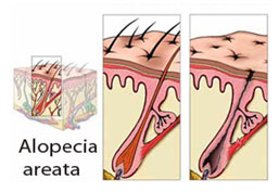 Alopecie definitie