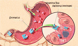 Anemia Pernicioasa