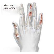 Artrita Psoriazica