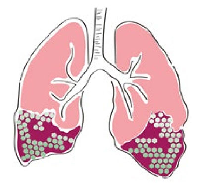 Fibroza Pulmonara Idiopatică